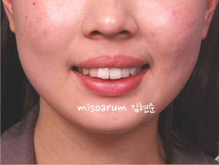 강남 돌출입 교정 관련 이미지 34