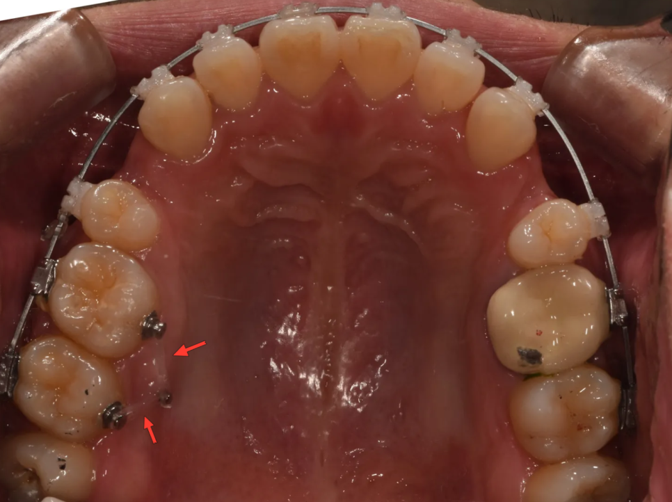 돌출입 교정 전후, 그런데 과개교합까지 있으셨던 환자분 관련 이미지 17