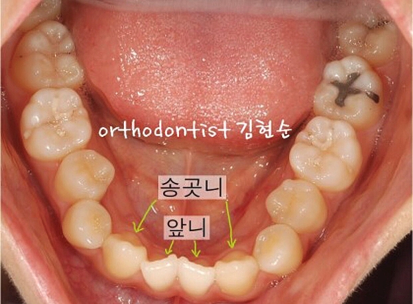 강남교정치과 관련 이미지 11