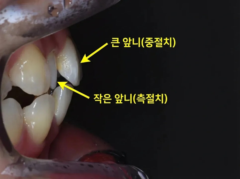 세라믹 치과, 삐뚤빼뚤한 치아를 교정 없이 라미네이트로 치료한 사례 관련 이미지 5