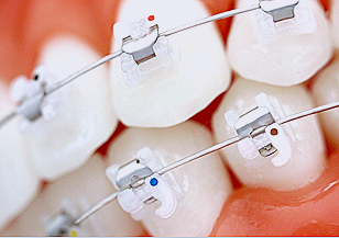 강남 세라믹 교정 관련 이미지 10