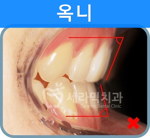 옥니 없이 치아교정잘하는곳, 강남 세라믹치과 관련 이미지 1