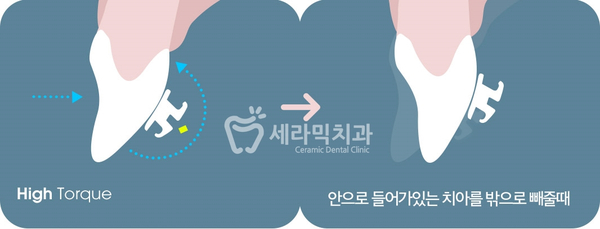 옥니 없이 치아교정잘하는곳, 강남 세라믹치과 관련 이미지 7