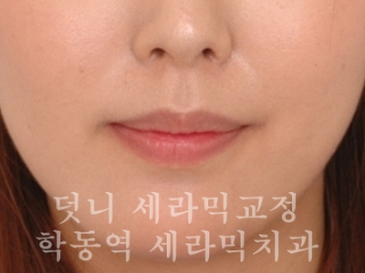 덧니교정 잘하는 학동역 교정치과, 세라믹치과 관련 이미지 6