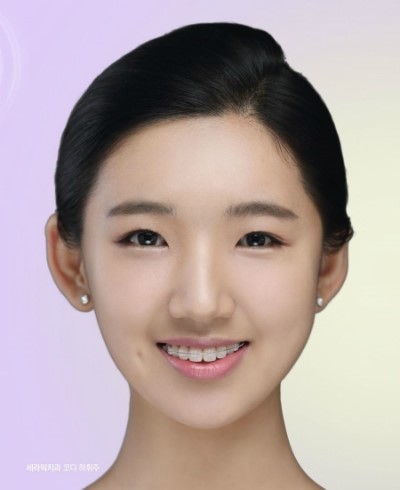 [세라믹치과 치아교정 칼럼] 아름다운 미소와 건강한 미소는 별개가 아닙니다. 관련 이미지 3