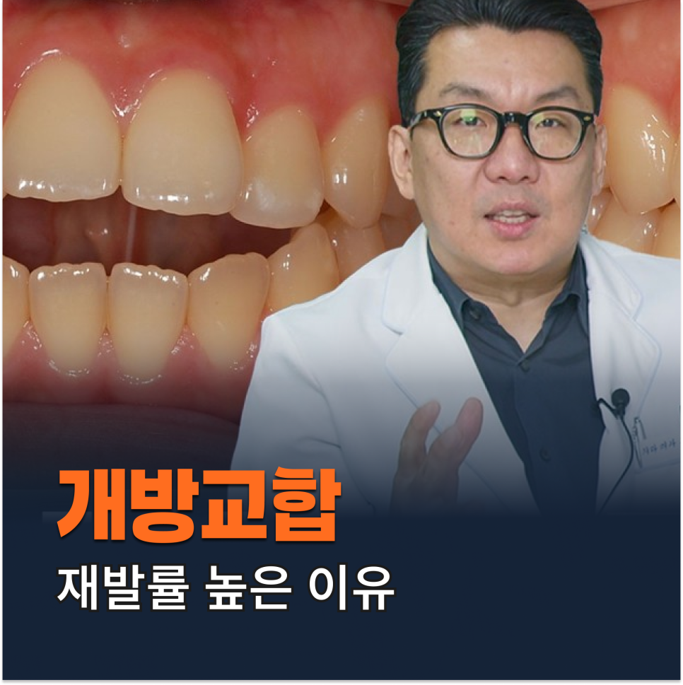 개방교합은 재발률이 높다? 치아교정 후 관리방법 (feat.유지장치) 관련 이미지 1