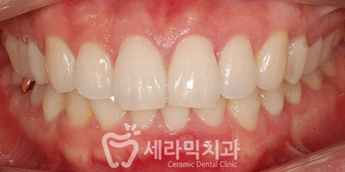 과개교합 비발치 치아교정전후 비교 관련 이미지 2