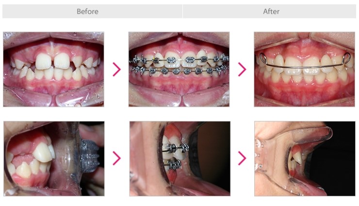 [소아교정/소아교정추천] 어린나이에 교정을 하는 이유는? 관련 이미지 5
