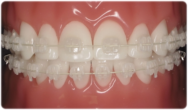 학동역 교정치과, 세라믹치과의 세라믹교정 관련 이미지 4