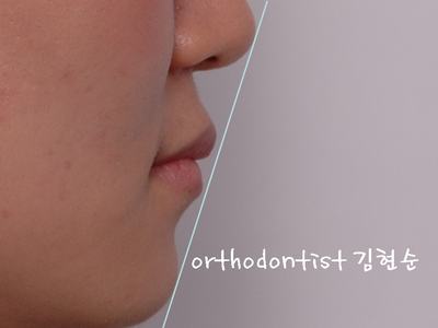 반대 교합 관련 이미지 33