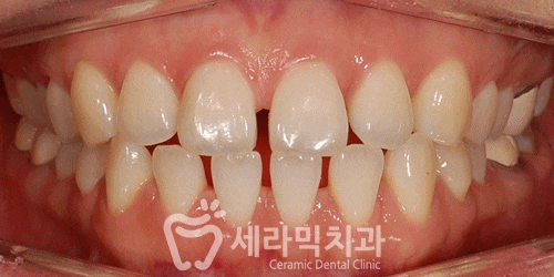 치아교정전후 : 치아사이틈, 벌어진 공간 치아교정으로 치료! 관련 이미지 1