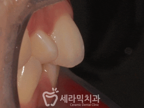 발치없이 치열불규칙교정으로 세련된 미소 완성! 관련 이미지 4