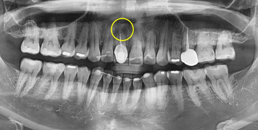 A Case of Improving the Smile Line Along with Replacing a Front Tooth Crown image 3