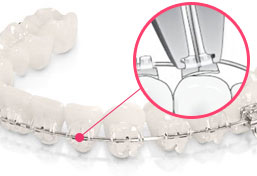학동역교정치과 세라믹치과 세라믹교정 관련 이미지 7