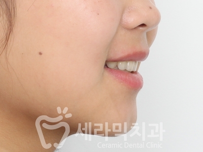 돌출입치아교정 전후사진(발치교정, 토끼이빨 인상변화) 관련 이미지 10