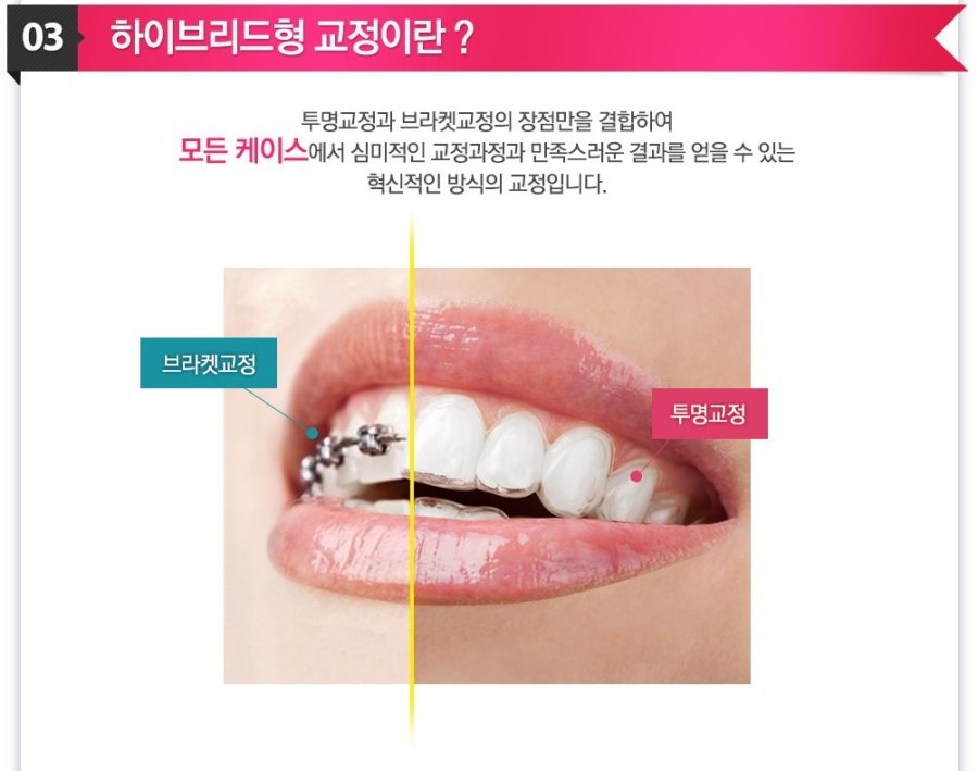 [ 학동역 치과 ] 투명교정의 새이름 3D miso 교정 관련 이미지 5