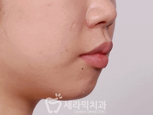 깨진 후에 후회하는 돌출입, 치아교정으로 건강하고 가지런한 치아만들기 관련 이미지 10