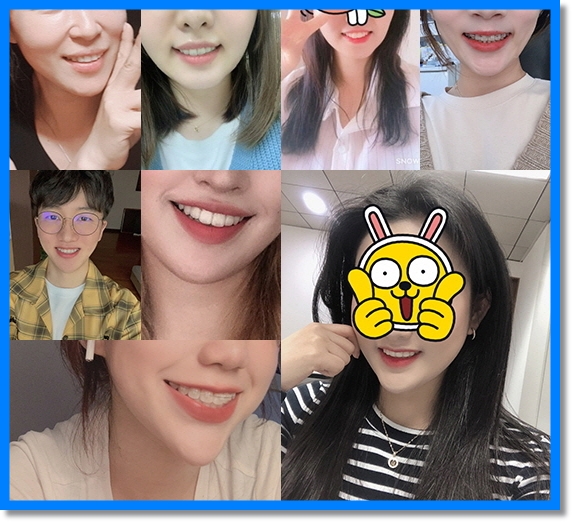 반대교합과 아래 돌출입 치아교정전후 관련 이미지 8