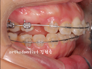 강남 돌출입 교정 관련 이미지 25