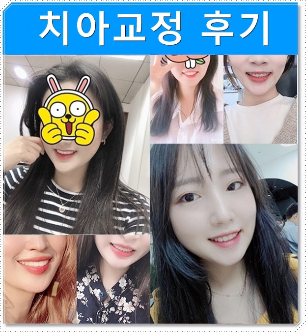 치아교정전후 돌출입, 나비치아 개선 관련 이미지 3