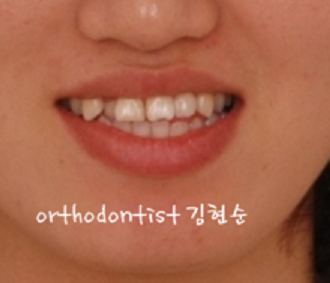 안면비대칭 교정, 치아교정만으로 간단히 해결하기 관련 이미지 1