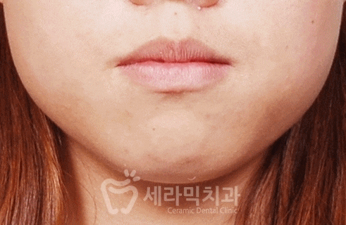 학동역 치아교정, 수술없이 예뻐져도 되나요? [돌출입교정 전후 달라진 외모] 관련 이미지 9