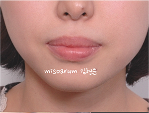 강남 돌출입 교정 관련 이미지 2