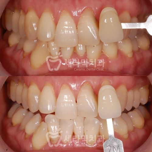 연말 치아미백 이벤트 , 학동역 세라믹치과 관련 이미지 7