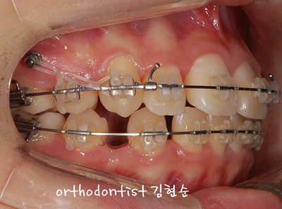 강남 돌출 (토끼 치아) 관련 이미지 24