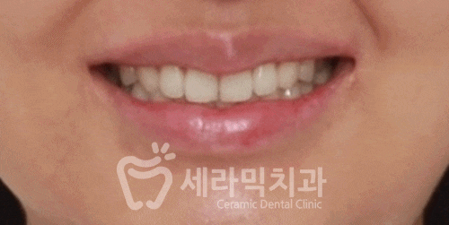 무삭제 라미네이트라면서? 대체 얼마나 삭제하는거죠? 관련 이미지 8