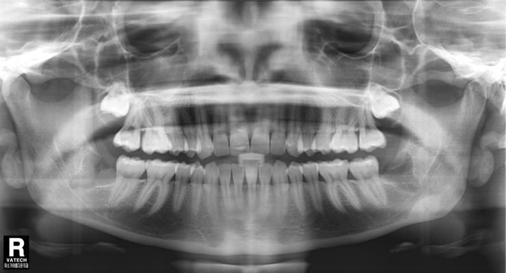 학동역 사랑니발치 관련 이미지 9