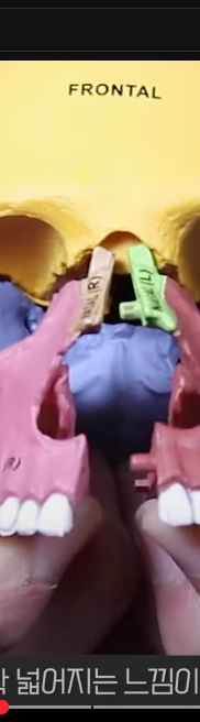 강남치아교정, 악궁확장하면 얼굴크기 커질까? 관련 이미지 10