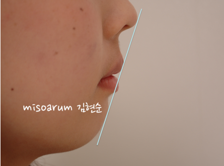 강남 돌출입 교정 관련 이미지 39