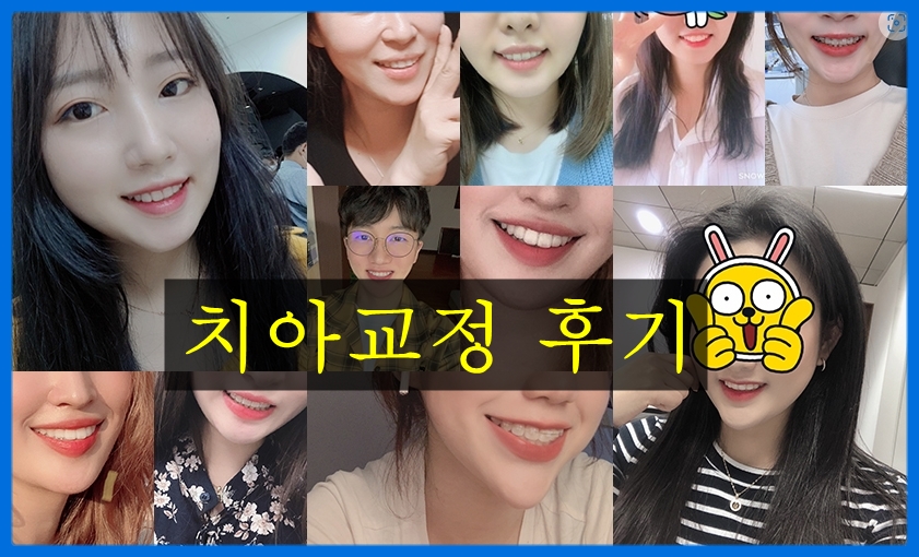 딥바이트 과개교합 치아교정전후 변화 관련 이미지 4