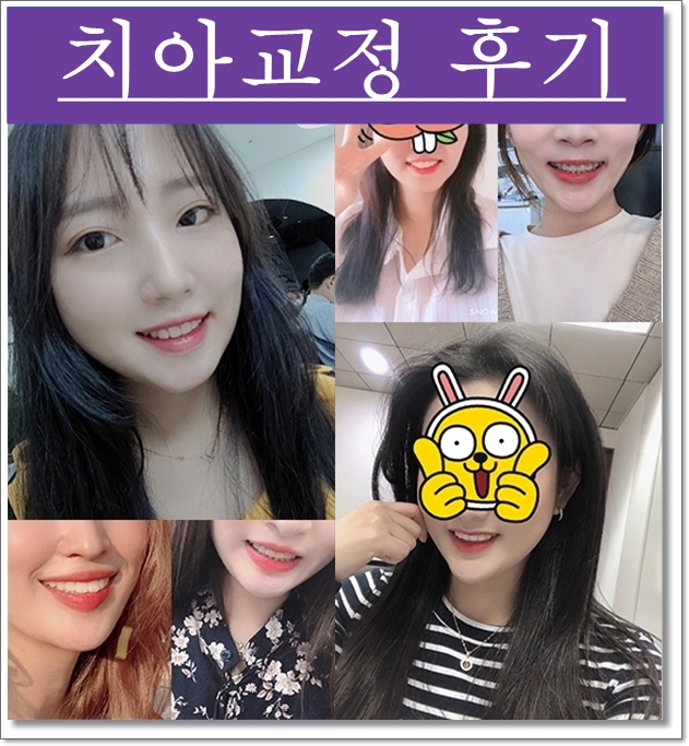 돌출입 치아교정전후 : 세련된 얼굴라인 찾기 성공! 관련 이미지 3