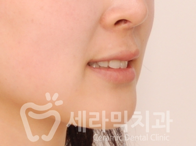 덧니 세라믹교정 전후사진, 학동역 세라믹치과 관련 이미지 7