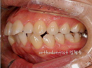 강남 돌출입 교정 관련 이미지 6
