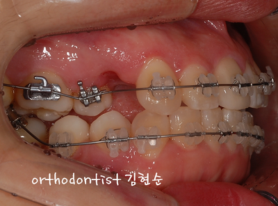 강남 덧니, 돌출 관련 이미지 22