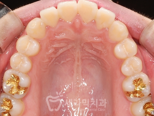 20대 돌출입교정, 무턱교정, 치아교정전후 세련된 얼굴 라인을 되찾다! 관련 이미지 7