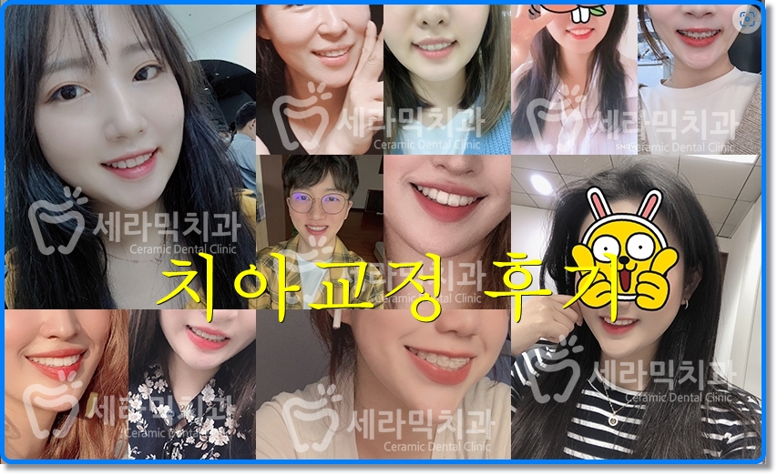 삐뚤빼뚤 치열불규칙 치아교정전후 달라진 미소 관련 이미지 5