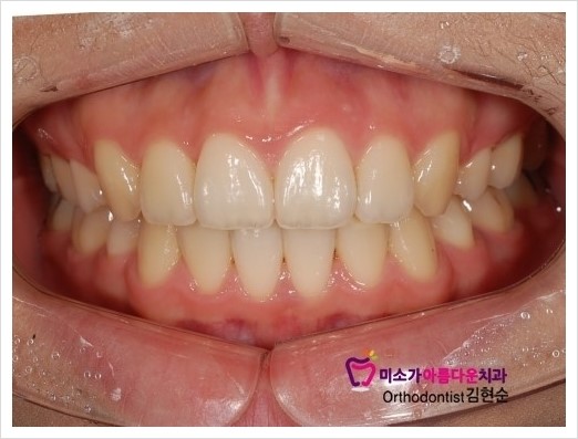 세라믹치과 돌출입교정치과 관련 이미지 3