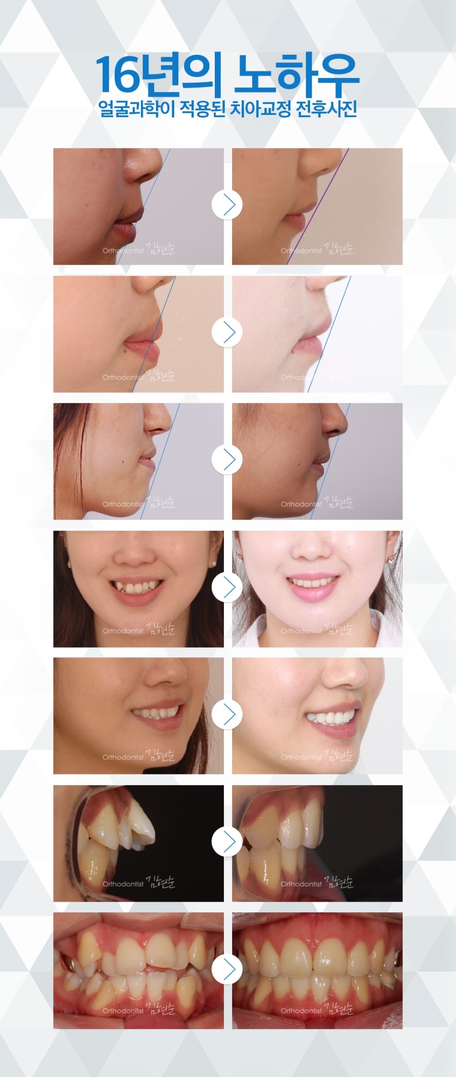 세라믹교정 이벤트 관련 이미지 13