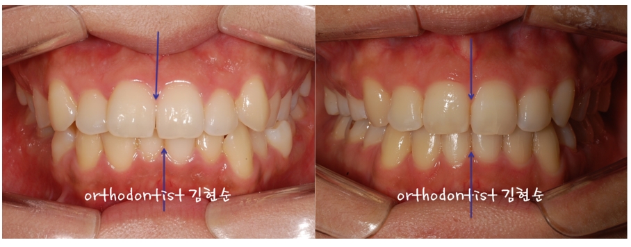 세라믹교정 은 세라믹치과 돌출입발치 관련 이미지 5