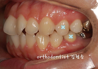 강남 돌출입 교정 관련 이미지 10