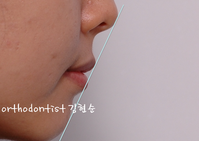 돌출 교정 (비발치 교정/비대칭) 관련 이미지 12