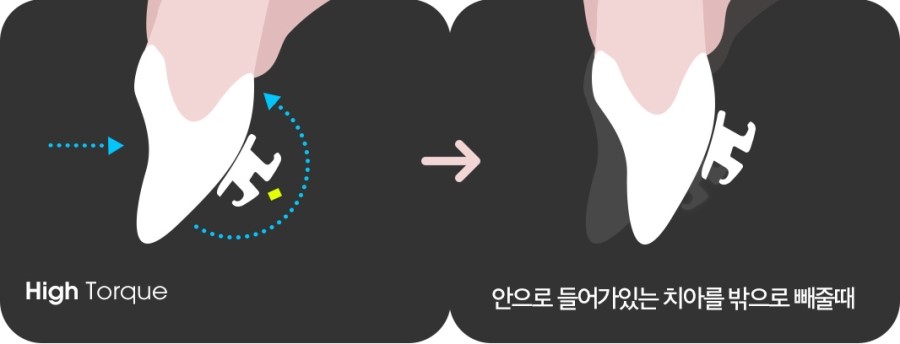 치아각도 교정과정 관련 이미지 8