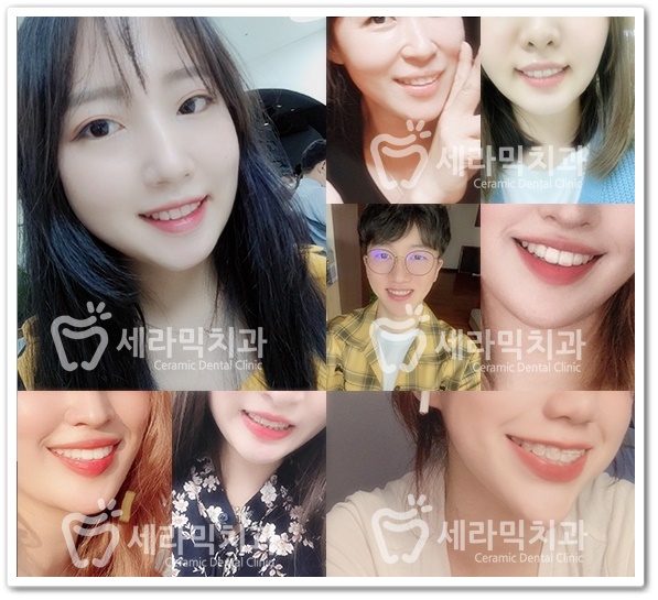 돌출입교정 치아교정전후(비수술, 발치교정) 영상 관련 이미지 2