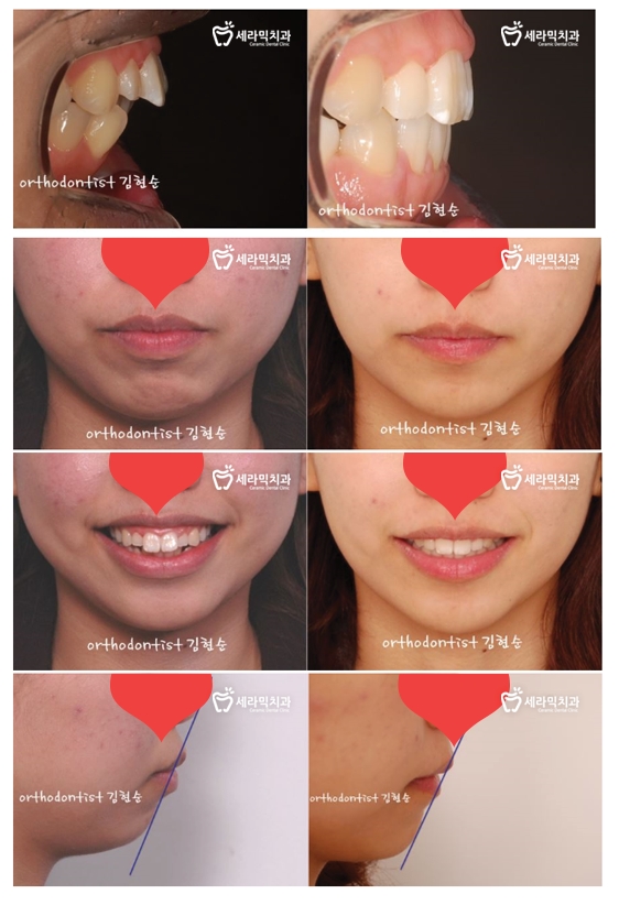 돌출입 교정으로 외모변화를 확인 관련 이미지 10