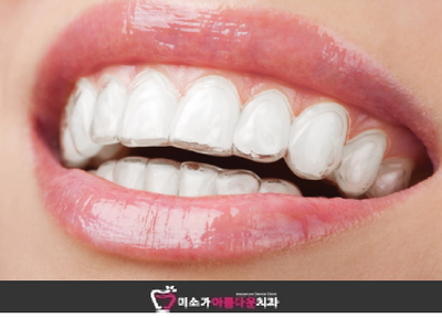 하이브리드형 차세대 교정 "3Dmiso교정" 관련 이미지 1