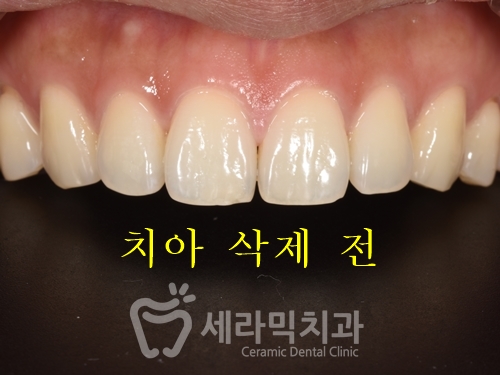 무삭제 라미네이트라면서? 대체 얼마나 삭제하는거죠? 관련 이미지 3